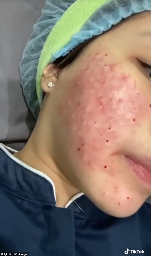 Another TikTok video posted by @hi.vega, who has more than 4,800 followers, shows her receiving the injections at a clinic. After treatment, her face is lumpy and covered in blood.