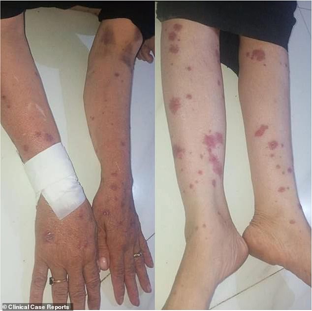 Rashes also appeared on the patient's extremities, as shown above. Tests revealed that the outer layer of his skin, which contains billions of healthy cells, had also sloughed off.