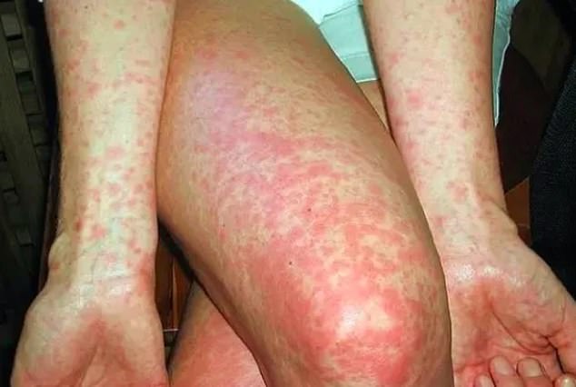 Symptoms of the disease include fever, poor appetite, drowsiness, pain in the legs, lack of energy and seizures or convulsions, while younger people may suffer a rash (pictured).