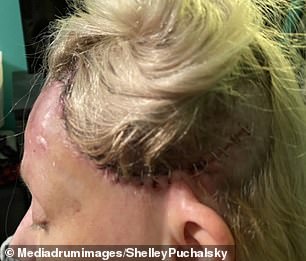 After tripping while running, Puchalsky drove to the nearest hospital with blood running down his face and had to receive more than 40 stitches.