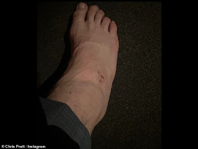 She also shared another photo of her bare right foot, showing how swollen it had become due to the injury.