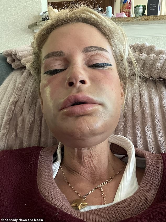 Her chin and neck were incredibly swollen after the procedure and then it spread across her face.