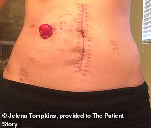 Ms. Tompkins had 12 inches of colon and rectum removed, as well as 17 lymph nodes, and an ileostomy bag was placed.