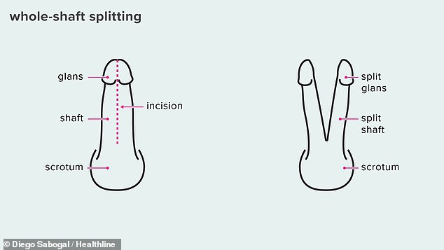 An illustration from Healthline shows the full shaft split, in which the entire penis is cut into two separate parts.  It is not known if the clinic does this.