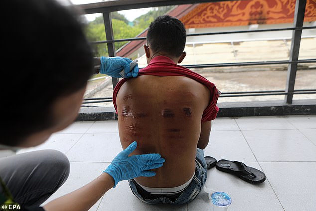 A doctor checks wounds on a man's back after receiving up to 20 lashes for violating Sharia law.