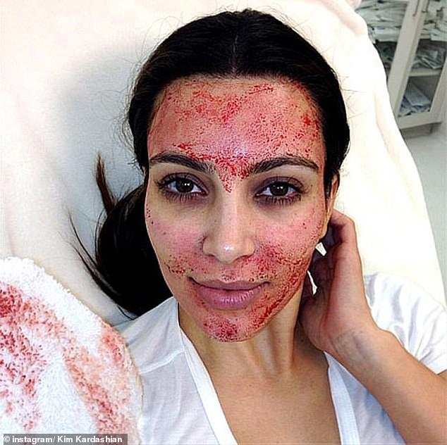 Kim Kardashian popularized the 'vampire facial' when she posted a selfie of her face covered in blood in 2013.