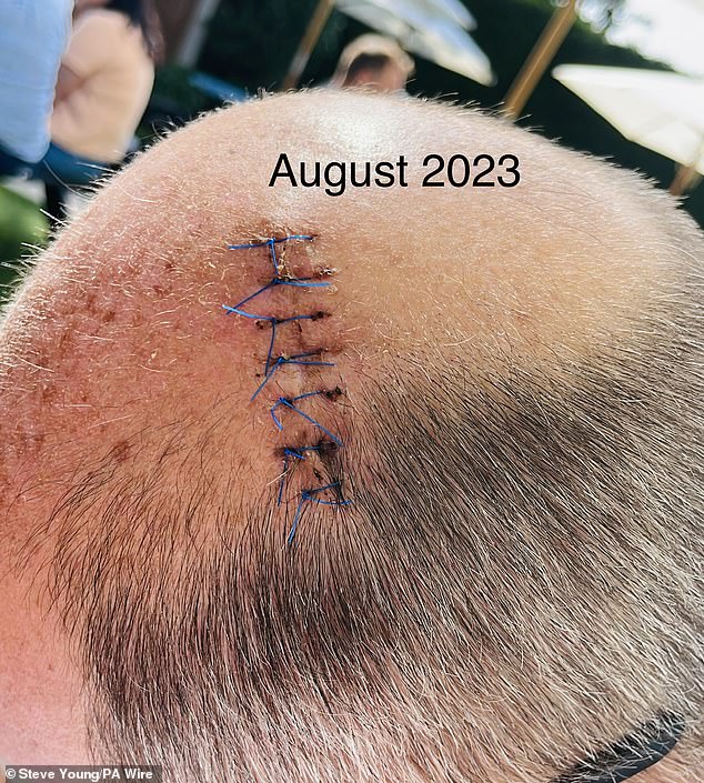 Ultimately, Mr. Young had the melanoma removed.  Here are the points he had in August of last year.