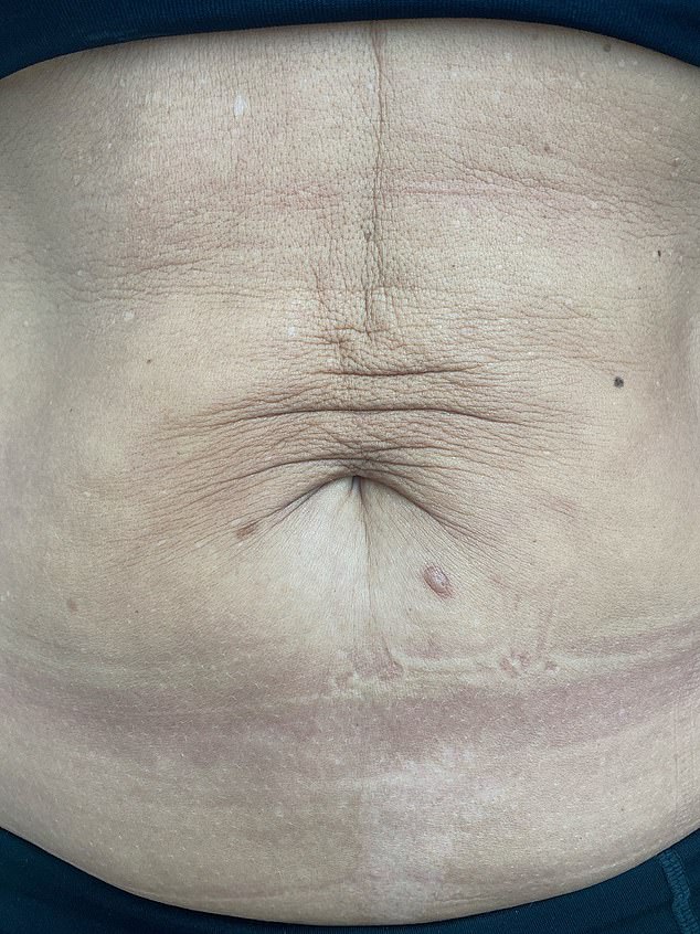 Women report that the £850 treatment gives noticeable results, erasing fine lines and sagging caused by ageing, sunbathing, weight loss and pregnancy.  In the photo: before treatment.
