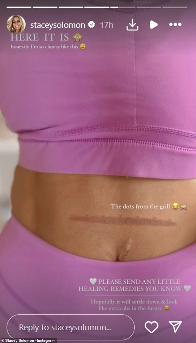 The Loose Women star asked her followers for 'help' as she showed off the large burn on her stomach while wearing purple gym gear.