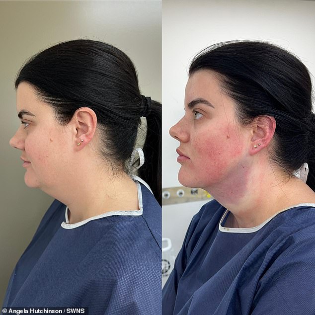 She saw another online influencer talk about undergoing chin liposuction, which prompted her to undergo the procedure.  Above: left, before surgery, just after surgery