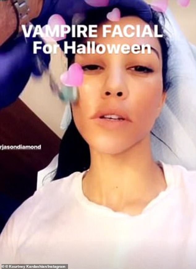 Kim's sister Kourtney also underwent the treatment, which involves injecting the patient's face with their own filtered blood plasma.