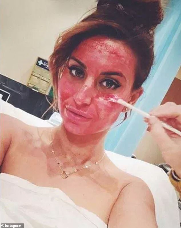 Ferne McCann also underwent a vampire facial, performed in 2016 to rejuvenate her face.