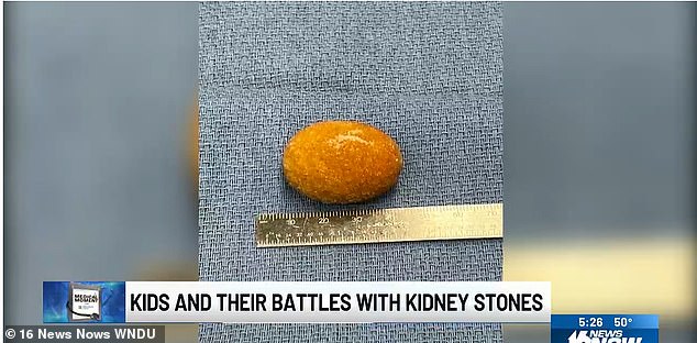 One stone in Alex's kidney was the size of a golf ball, while another in his bladder was the size of a lacrosse ball.