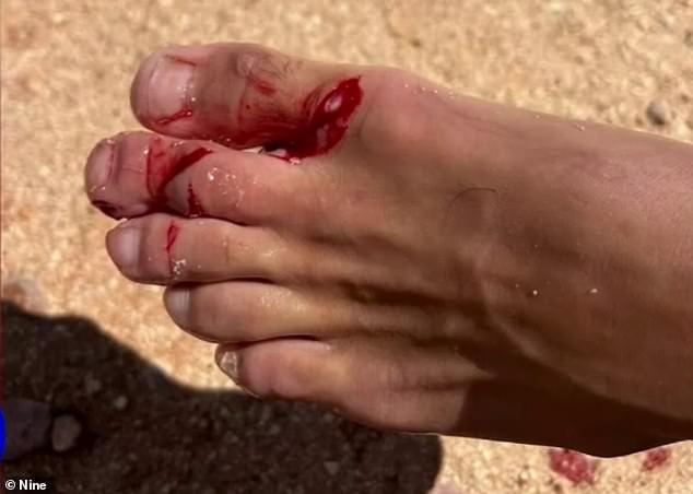 The Argentine backpacker said he initially thought he had lost his toe, but when he realized it was still there, he immediately started laughing.