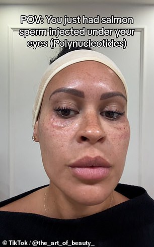 A Surrey-based aesthetic nurse @the_art_of_beauty who has just over 1,000 followers, also posted a video of her face just after receiving the under-eye treatment.