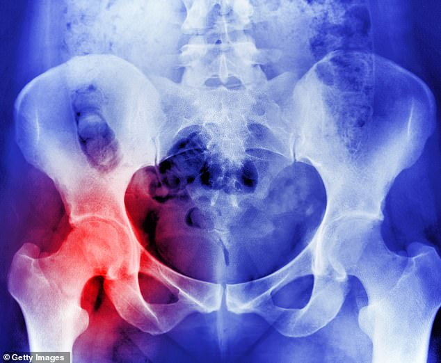 An x-ray showing osteoporosis resulting in a hip replacement