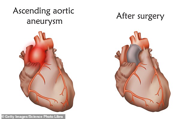 If you have an ascending aortic aneurysm that grows large enough to require treatment, doctors sometimes implant surgical mesh around the vessel to support it.