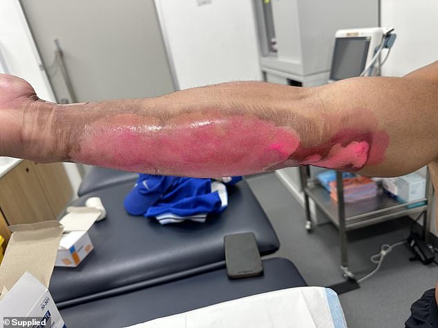 Canberra Raiders star Albert Hopoate has shared the extent of the burns on his arm from the freak accident involving a barbecue and an olive oil bottle that caught fire.