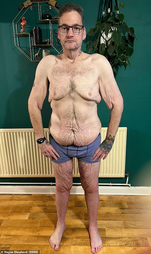 Wayne Shepherd, 41, from Little Downham, Cambridgeshire, who lost a staggering 24 stone, has told how he now faces paying £40,000 to have the excess skin removed because the NHS will not fund the operation.