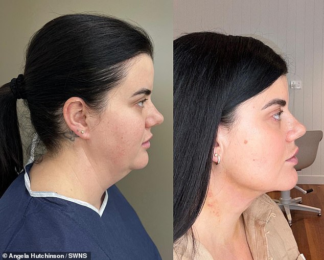 Angela Hutchinson, from Central Coast, New South Wales, Australia, underwent the procedure after struggling with her chin since she was a teenager.  Above: left, before surgery, right, after surgery