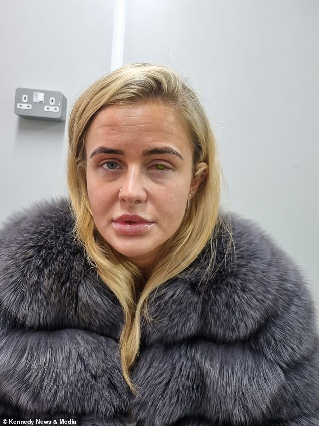 Lillie Barrett, 22, from Welling, south-east London, bought an expensive pair of Russian eyelash extensions, but soon after she started experiencing itching in her left eye and even went temporarily blind.