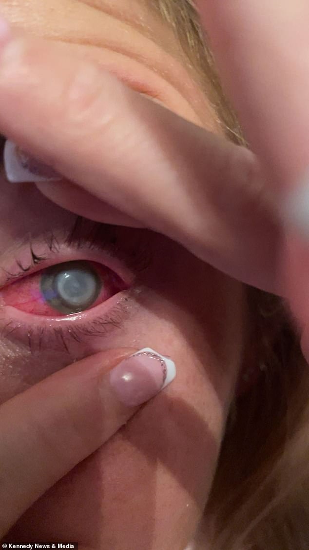 Pictured above is the gruesome eye infection - a corneal ulcer believed to have been caused by Lillie's contact lenses.