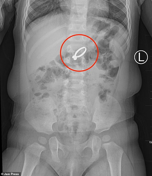 An X-ray image revealed that the diamond ring was in the boy's abdomen