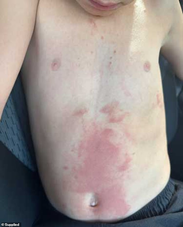 After a terrifying experience, a Sydney mother has warned all parents about the unexpected dangers of a food commonly found in Australian homes.  The photo shows the rash it caused on Max's stomach.