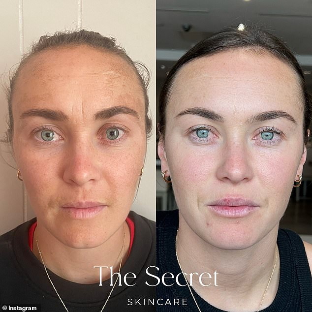Matildas football superstar Caitlin Foord has revealed how she transformed her skin after years of sun damage and pigmentation sapping her confidence.