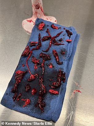 The 20 red blood clots found on a piece of cloth after they were removed from Mrs Ellis' right leg.