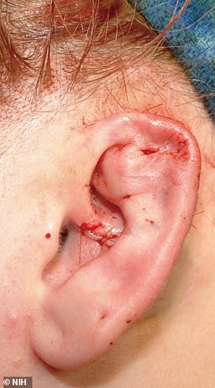 The 17-year-old patient's ear after reconstructive surgery, following her serious cartilage infection.