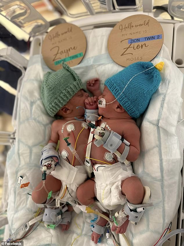 Zayne and Zion were born joined at the sternum and abdominal wall (sharing a liver, some blood vessels and muscles) at University College Hospital in London in April 2023.