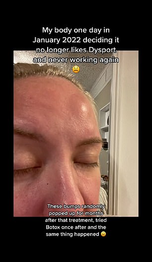 After about eight years of taking Botox alternative Dysport, Holly Brooke shared on TikTok that she started getting bumps on her forehead.