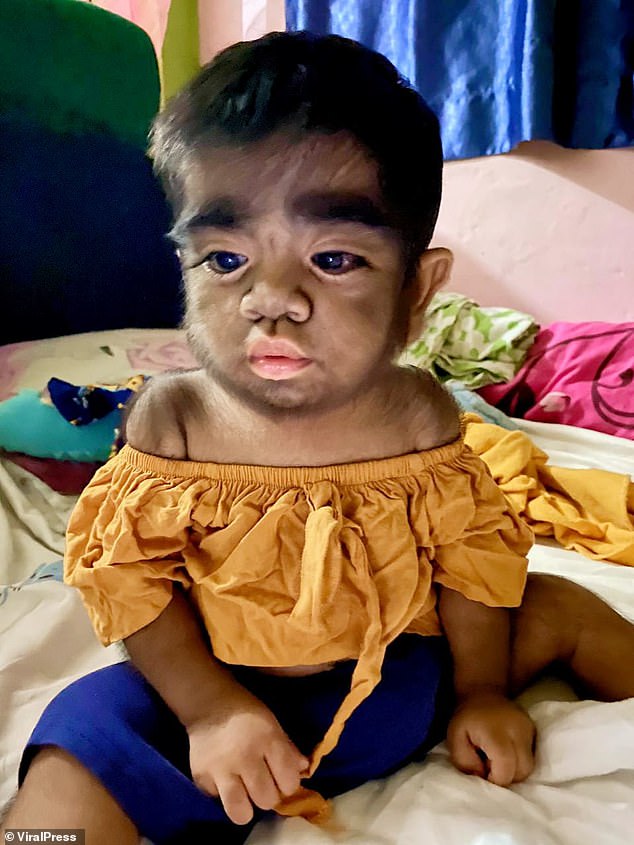 The mother feared that her sons werewolf syndrome was caused