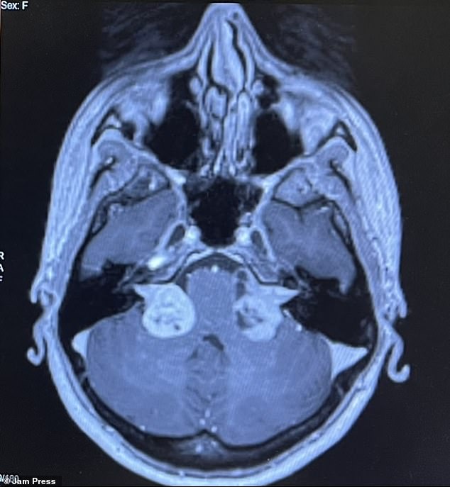 This rare disease, also known as NF2-SWN, causes noncancerous tumors to grow throughout the nervous system. During an MRI for a dancer's injury when she was a teenager, doctors diagnosed her