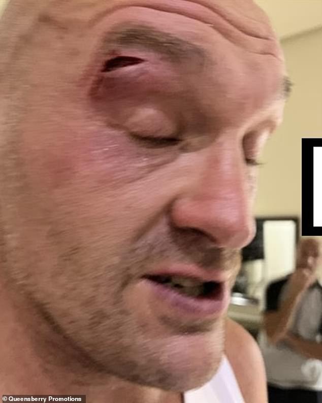Fury suffered a nasty laceration above his right eye that postponed his fight until May.