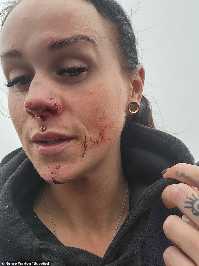 Ballarat woman Renee Warton was left with a shattered nose, back and neck after being hit by a truck in foggy conditions on Victoria's Western Freeway.