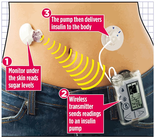 World first artificial pancreas roll out will see up to 150000 diabetics