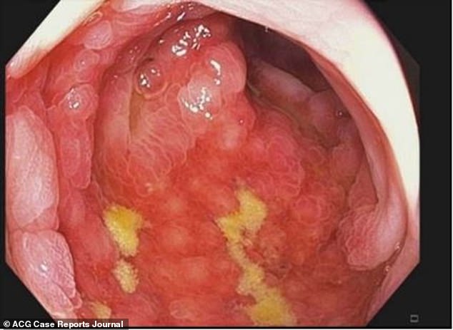 In this image of the patient's colon, the researchers pointed out inflammation and tissue damage due to ischemic colitis.