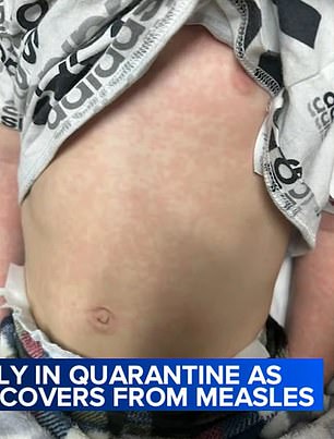 A measles rash is shown spreading all over his body.