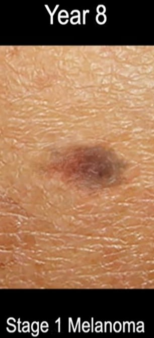 The above shows stage 1 melanoma.