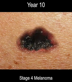 And at the end, when it was stage four melanoma