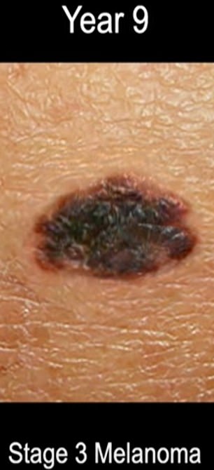 This shows stage three melanoma.