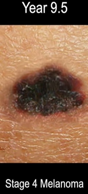 And this shows stage four melanoma.