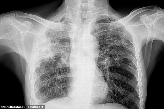 Tuberculosis is a serious disease that usually attacks the lungs, according to the CDC.  The bacteria is spread through the air when an infected person coughs, sneezes or talks.  The photo shows a file photograph of a chest x-ray of the patient with tuberculosis.
