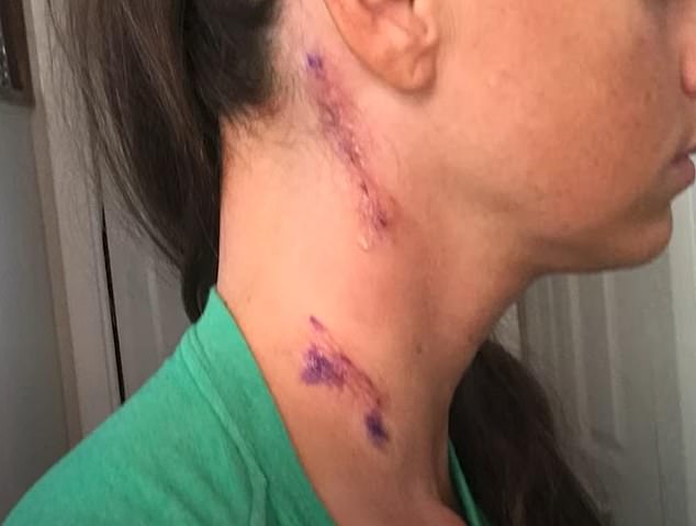 In 2017, Ms Sue underwent surgery to remove lymph nodes from her neck and test them for cancer after a dermatologist found a suspicious mole on her body.
