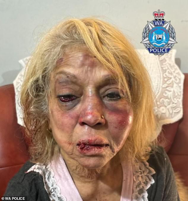 Ninette Simons (pictured after the alleged attack) and her husband were targeted in a home invasion when three men allegedly entered their home posing as police officers.