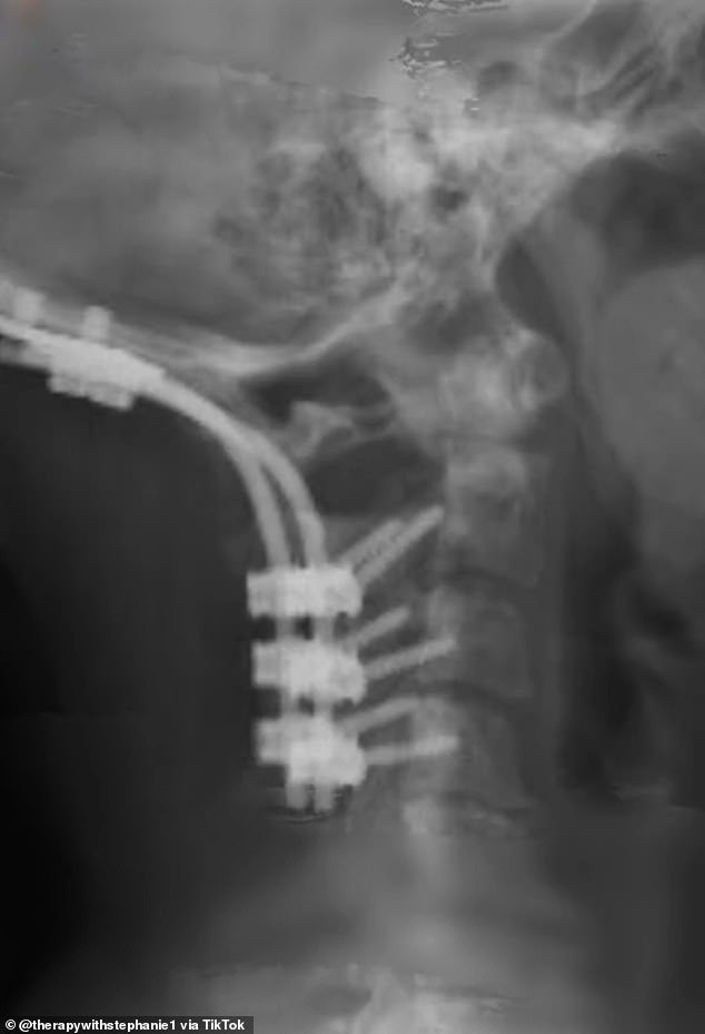 A device had to be surgically inserted into his neck to repair the dislocation.