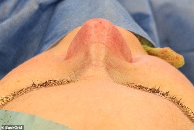 The photo shows the results of the nose surgery.