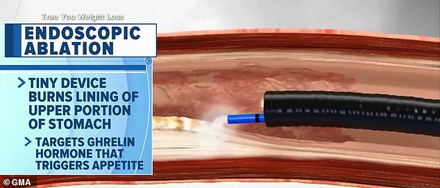 There are currently no pharmacological options to reduce the hunger hormone ghrelin. The procedure, if it becomes widespread, would give people a non-surgical alternative to gastric sleeve or bypass surgery.